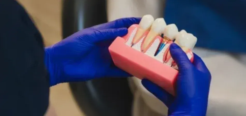 Ein Arzt hält ein Zahnmodell, das ein Implantat neben natürlichen Zahnwurzeln zeigt