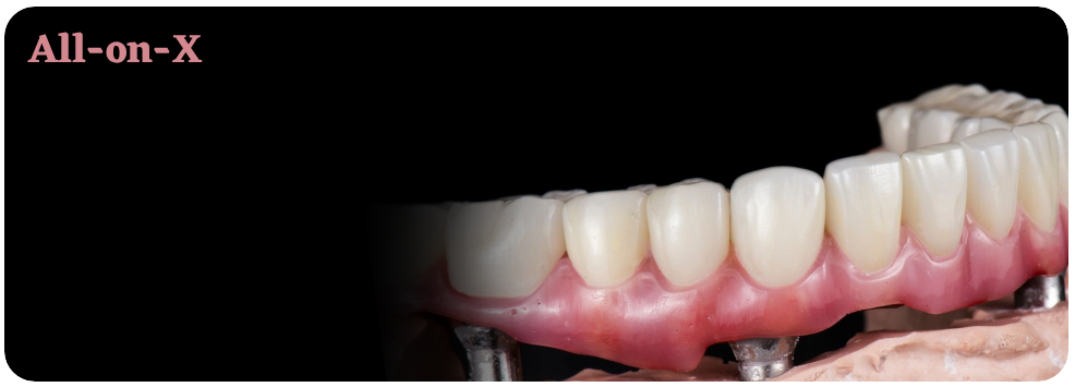 All-on-X – odbudowa pełnego łuku zębowego na implantach