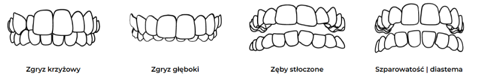 Przezroczyste nakładki ONCE Aligner – etapy leczenia